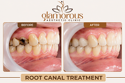 Results OF Root Canal Treatment Islamabad