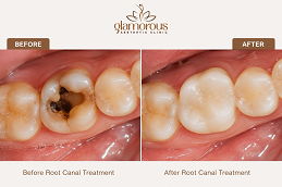 Results OF Root Canal Treatment clinic Islamabad