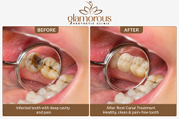 Root Canal Treatment Before & After in Islamabad