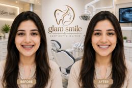 Result Of Invisible Braces In Pakistan