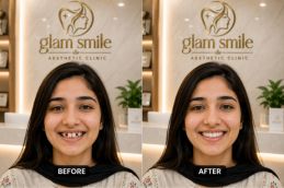 Alignar Treatment Before & After Clinic Islamabad