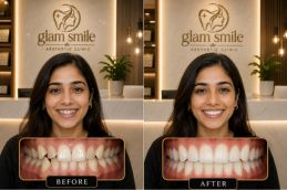 Alignar Treatment before & After Pakistan