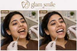 Before & After Teeth Scaling In Islamabad