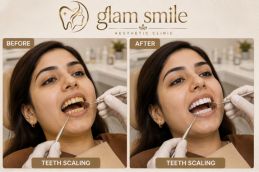 Before & After Teeth Scaling clinic In Islamabad