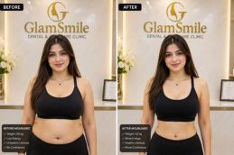 Before & After of mounjaro injection