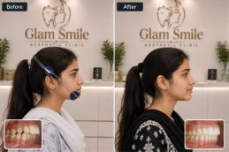 Before And After headgear Treatment In Islamabad