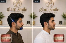 Before And After headgear Treatment In Pakistan
