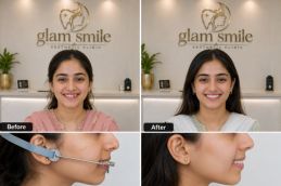 Before And After headgear in Islamabad