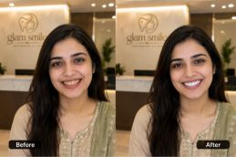 Before And After teeth removal in Islamabad (1)
