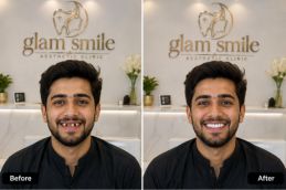 Before And After teeth removal in Islamabad