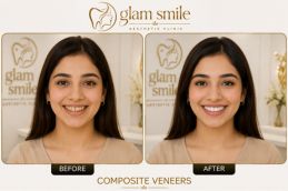 Composite Veneers Before & After In Islamabad