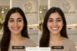 Composite Veneers Before & After clinic Islamabad
