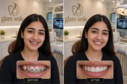 Dental Braces Before And After Pakistan