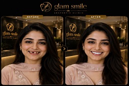 Dental Implant Before & After Pakistan