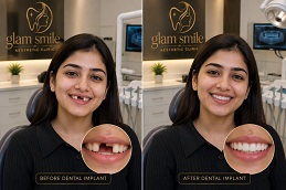 Dental Implant Before & After
