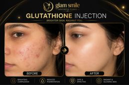 Glutathione Injection before and after result