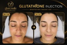 Glutathione Injection before and after result