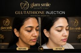 Glutathione Injection before and after