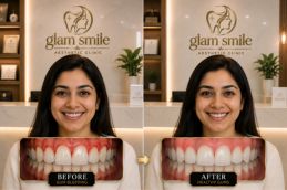 Gum Bleeding Before & After Pakistan