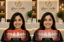 Gum Bleeding Before And After Clinic In Islamabad