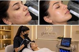 HydraFacial before and after results at Glam Smile Clinic