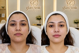Hydrafacial Results Islamabad Glam Smile