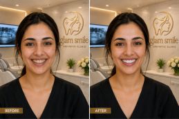 Result Of Composite Veneers In Islamabad