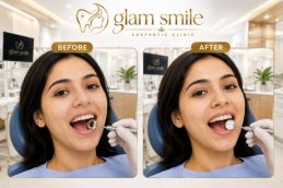 Result Of Dental Filling In Islamabad
