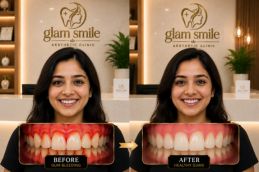 Result Of Gum Bleeding Clinic Islamabad