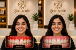 Result Of Gum Bleeding In Pakistan