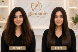 Result Of Karatin Treatment In Islamabad