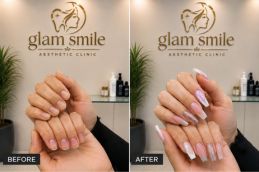 Result Of Nail Extention Clinic Islamabad