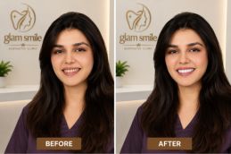 Result Of Smile Makeover In Islamabad