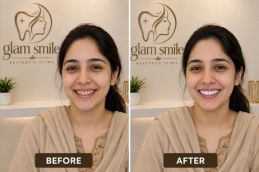 Result Of Smile Makeover In Pakistan