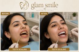 Result Of Teeth Scaling clinic in Islamabad