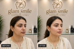 Result Of Thread Lift In Islamabad