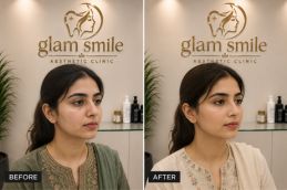 Result Of Thread Lift In pakistan