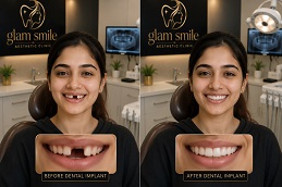 Result Of dental Implant Clinic Islamabad