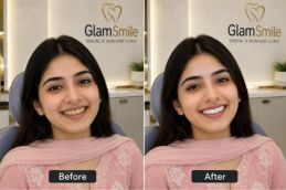 Result of Teeth Whitning In Islamabad