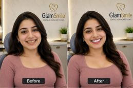 Result of Teeth Whitning In Pakistan