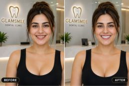 Result of Teeth Whitning before and after in Islamabad (1)