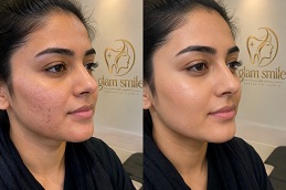 Results OF Hydra Facial in Islamabad