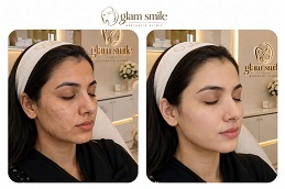 Results OF Skin Whitening Treatment in Pakistan