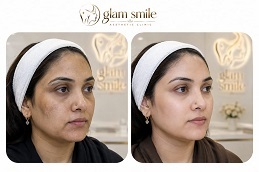 Results OF Skin Whitening Treatment