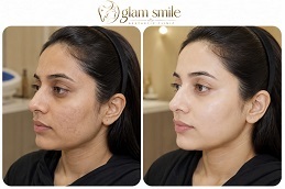 Results OF Skin Whitening clinic Islamabad Pakistan