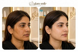 Results OF Skin Whitening in Islamabad
