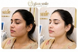 Results OF Skin Whitening clinic Islamabad Pakistan