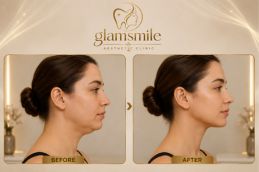 _Thread Lift Before & After Clinic In Islamabad