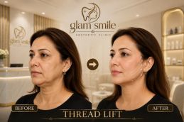 _Thread Lift Before & After In Islamabad