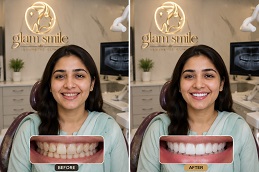 Result of Dental Implant In Pakistan